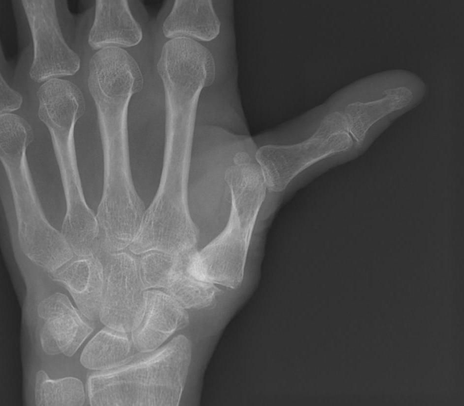 RA Swan Neck Deformity